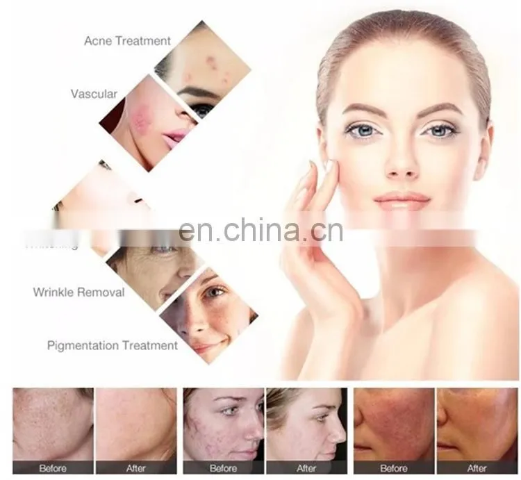 Ipl Hair Removal Laser Ipl Mini Laser Hair Removal Machine Ipl Hair Removal Painless At Home