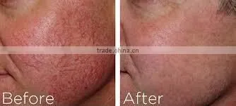 New shr ipl equipment professional IPL SHR&E-light hair removal elos laser