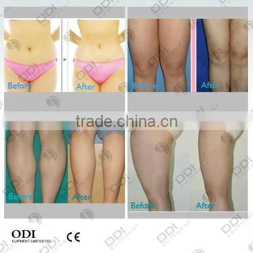 OD-C100 OEM body weight loss Fat Freezing belly fat loss slimming equipment