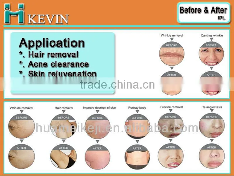 China PL machine for hair removal and skin rejuvenation