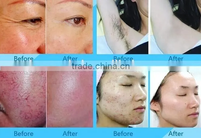 portable ipl beauty machine hair removal machine prices