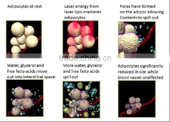 lipo lovely laser light / laser machine for weight loss / lipo laser for sale