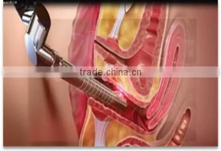 ThinkBig!!!cosmetics manufacturing equipment vaginal tightening stick for beauty salon use