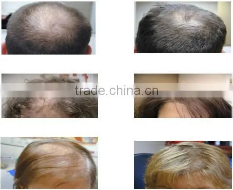 ce approval diode laser hair regrowth machine/laser cap for hair regrowth