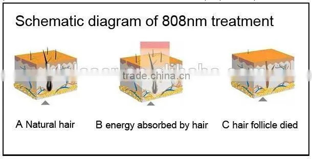 hot newest Germany 808nm diodes laser hair removal product