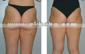 Vacuum cavitation RF ultrasonic tripolar / RF slimming touch screen machine Eversun (Glary-710)