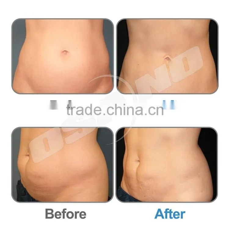 medical aesthetic vacuum roller cryo slim G 5 celulite machine