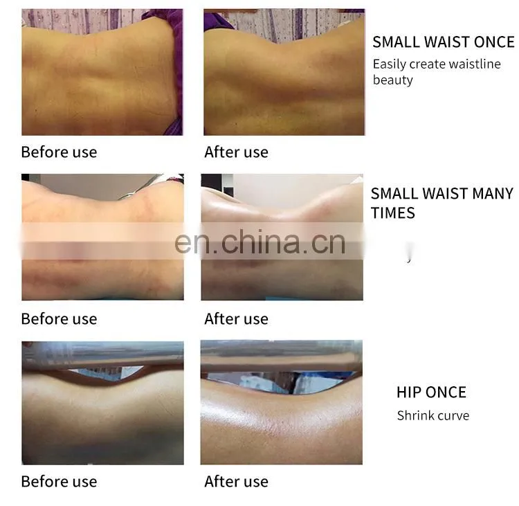 RF Vacuum Microwave Fat Crushing Body Shaping Instrument Cellulite Reduction Cupping Therapy Weight Loss Body Slimming Machine