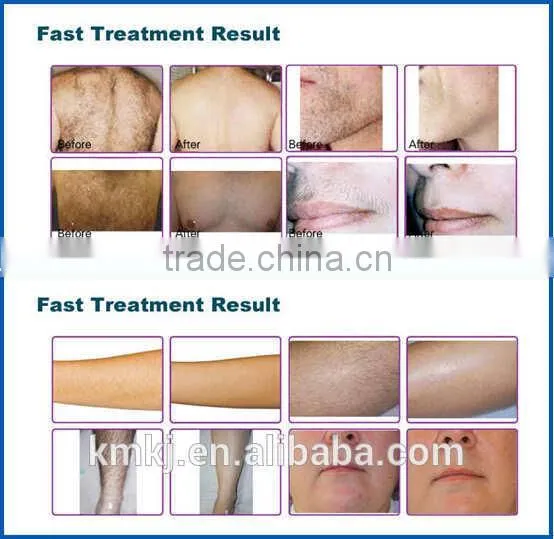 2016 Newest 808nm diode laser/808nm high power laser diode