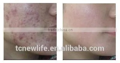 NL-PDT 500 2016 Anti-aging PDT LED facial therapy beauty devices for sale
