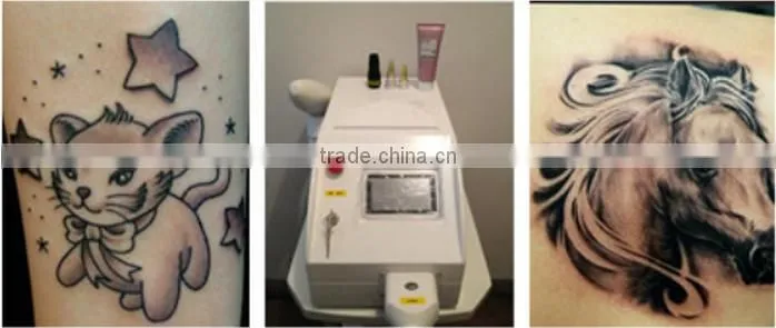 Beijing Sanhe manufacturer portable q switched nd yag laser tattoo removal and skin rejuvenation/powerful nd yag laser