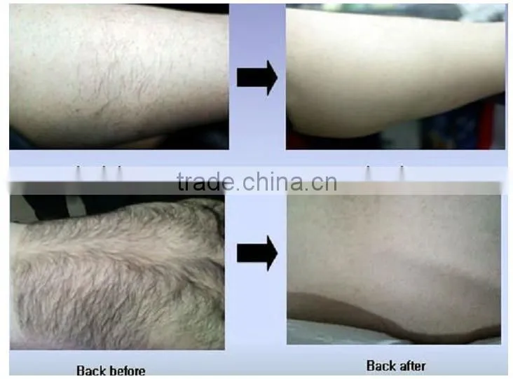 skin rejuvenation/SHR 808/810nm lightsheer diode lazer
