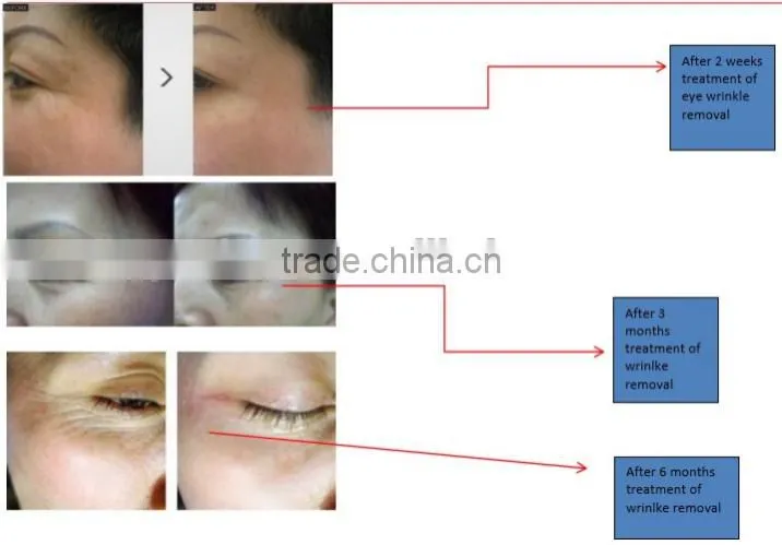 beauty machine eye care system for eye bag removal for wrinkle removal
