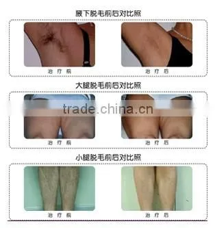 Factory Price high quality 808nm diode laser hair removal machine / diode laser pad