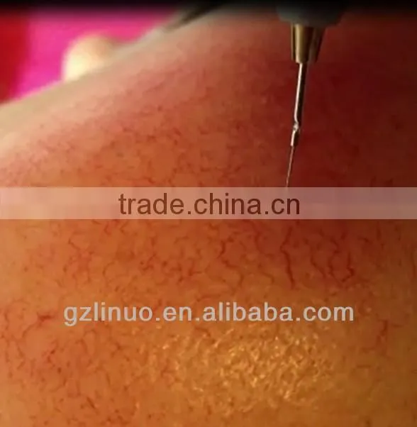 Excellent portable red vascular laser treatment