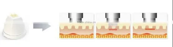 fractional rf microneedle / fractional radiofrequency micro needling / fractional rf microneedle face treatment