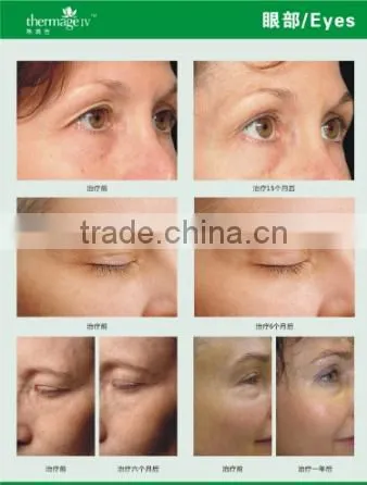 AYJ-C19(CE) Dot matrix portable thermal rf beauty equipment fractionel