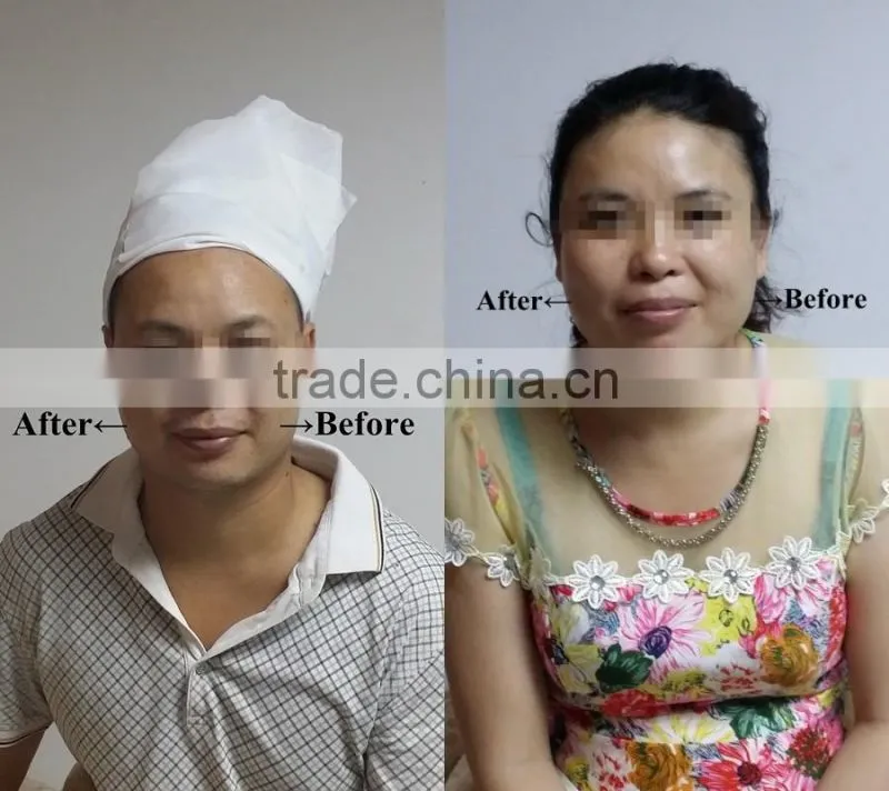 Hot Selling in Europe!! hifu Anti-wrinkle/ ultra age hifu/hifu equipment