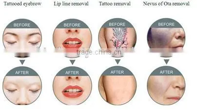 Brand Virtue Beauty 2016 Powerful ND YAG LASER tattoo removal