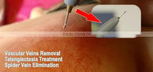 Hottest in the market!!!! super 30mhz Ultra high freqeuncy spider vein removal