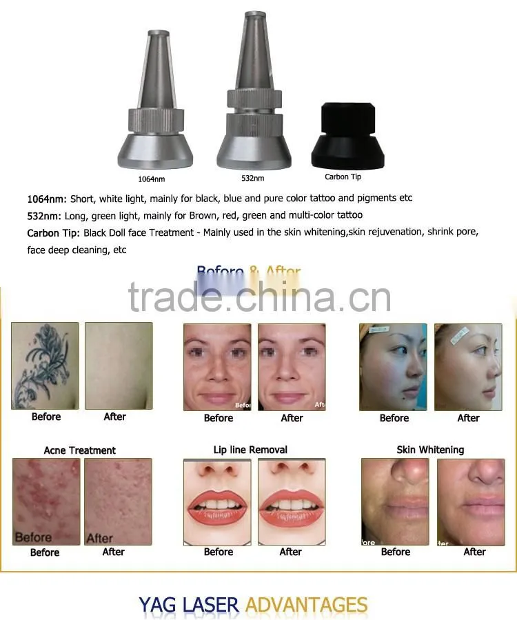 35%OFF! CE Approval Commercial yag laser tattoo removal machine price