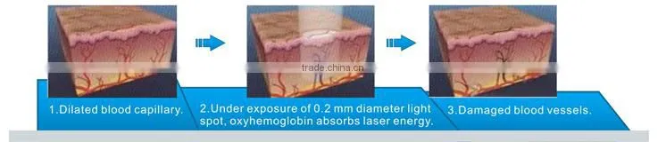 2016 Hot seller Professional Ultrapulse Laser Vein Removal Machine/Vascular Spider Veins Removal