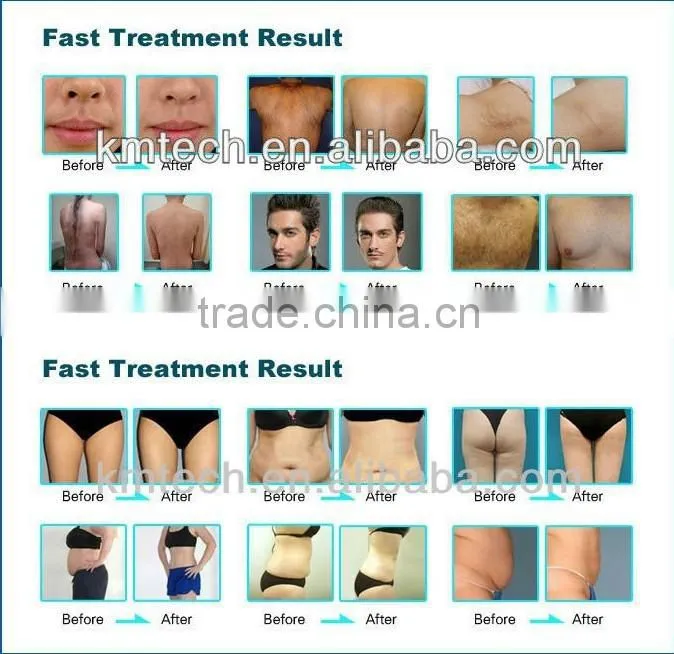large promotion !hotest 5in1 Elight+Ipl+RF+laser+cavitation beauty salon equipment