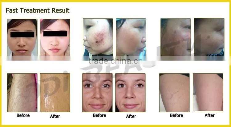 High Quality New Design mini ipl hair removal machine OD-Mini70