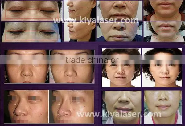 Most popular hifu treatment