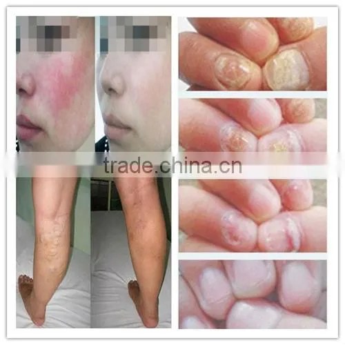 highly technological cost-effective laser machine hair removal/equipment for the small business P003