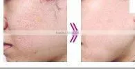 laser tattoo removal q switch nd yag laser