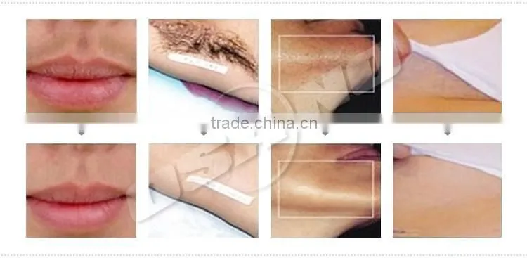 Worldwide Distributors Wanted IPL Hair Loss Treatment For Men With IPL Filter Machine Price