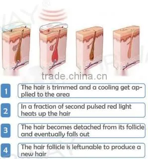 alexandrite laser 755nm hair removal equipment /Alex laser hair removal equipment