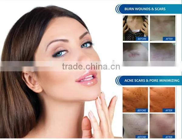 9/12/36 needle cartridges Dr.pen micro system skin micro needling derma meso pen
