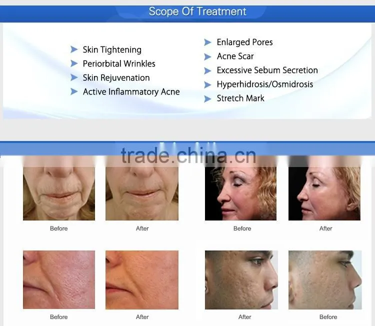 2 professional treatment handles rf fractional electric stretch mark micro needle
