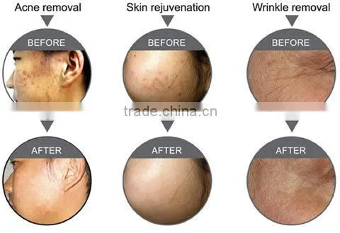 Big Promotion!!! high performed Portable Fractional rf equipment for skin resurfacing