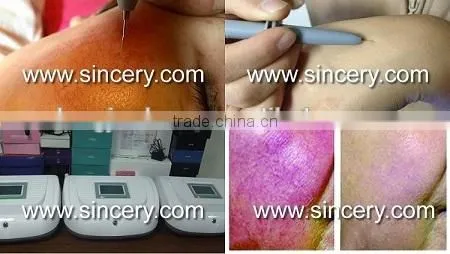 High quality portable vascular vein removal machine/spider vein removal