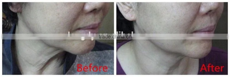 anti ageing machine korea HIFU face lifting LANGDI