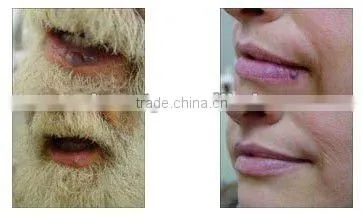 Portable Mobile Spa Equipment 1064nm Laser Hair Removal Machine -P003