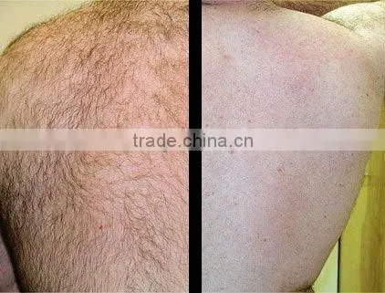 Cooling system 1mm-12mm laser depilation for hair removal,nail fungus laser --P001