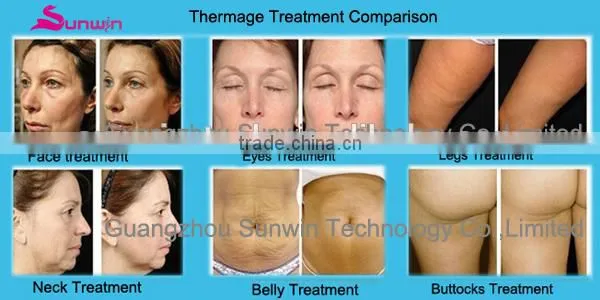 (SW-008B)Fractional RF Thermagic Home use & Salon Beauty Equipment
