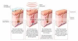 Salon distributors wanted spa use 808 diode laser epilator