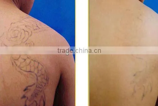 Portable medical design nd yag laser remover tattoo machine 2013