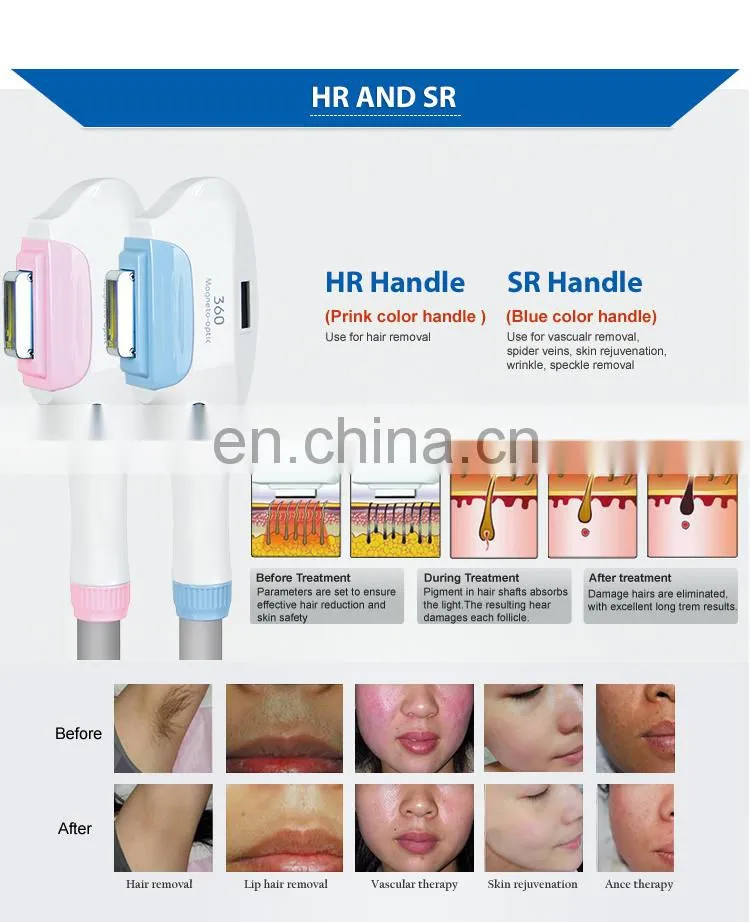 5 in 1 epilator hair removal and nd yag laser China supplier