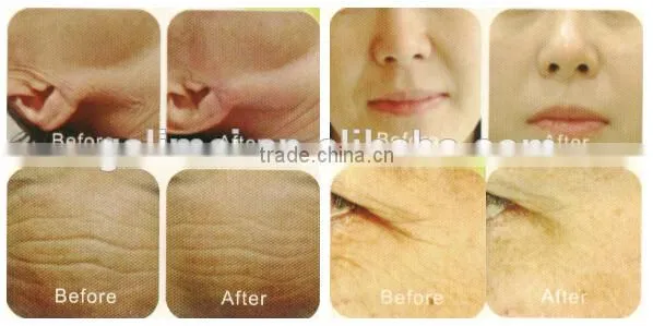 Super cold and heat hammer wrinkle removal/skin tightening thermal rf fractional machine