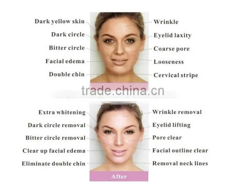Hottest 2 in 1 needle free mesotherapy rf facial machine