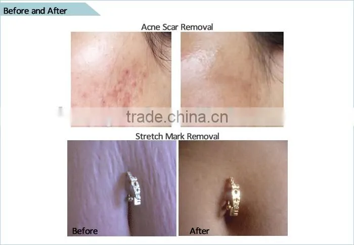 Dermaroller microneedling skin therapy