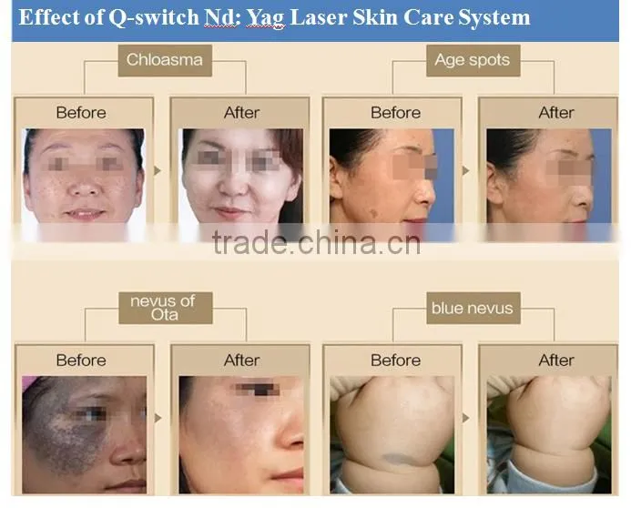 Merry christmas! 1064 532nm Tattoo Removal Active EO Q Switch ND YAG Laser machine with fast frenquency