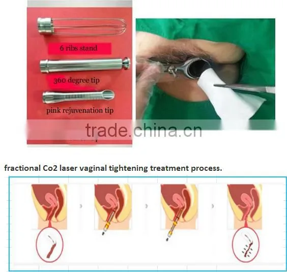 powerful laser 3 in 1 for dermatology and gynaecology use
