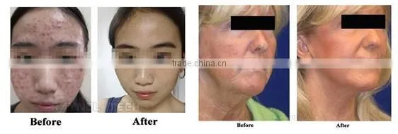 Beauty Salon Equipment Professional 7 Color PDT LED Skin Rejuvenation